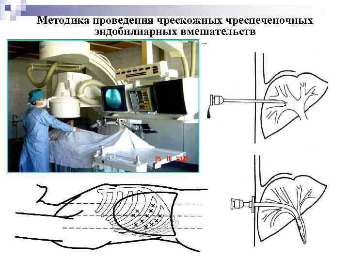 Методика проведения чрескожных чреспеченочных эндобилиарных вмешательств 