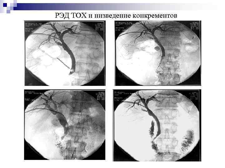 РЭД ТОХ и низведение конкрементов 