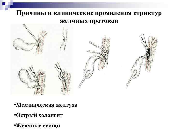 Причины и клинические проявления стриктур желчных протоков • Механическая желтуха • Острый холангит •