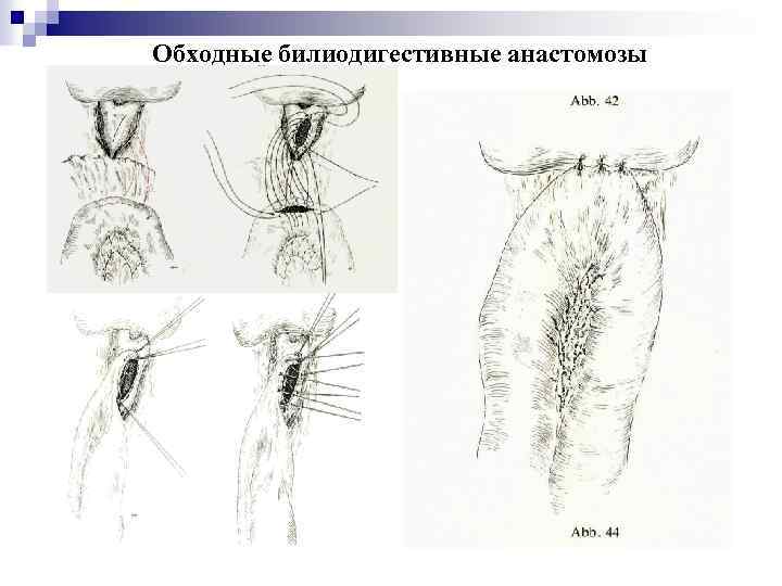 Анастомоз по брауну схема