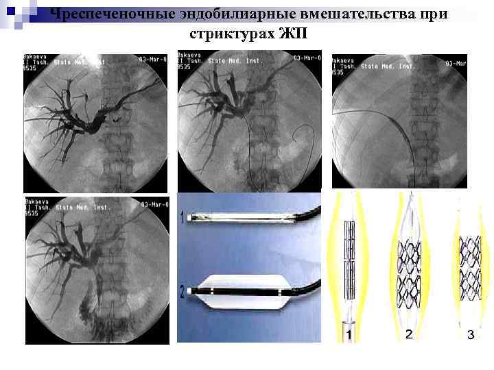Чреспеченочные эндобилиарные вмешательства при стриктурах ЖП 