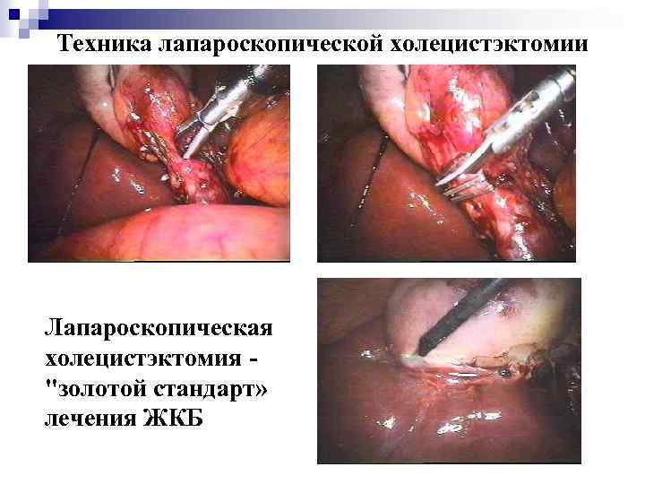 Техника лапароскопической холецистэктомии Лапароскопическая холецистэктомия 