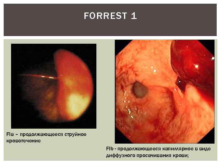 FORREST 1 FIa – продолжающееся струйное кровотечение FIb - продолжающееся капиллярное в виде диффузного