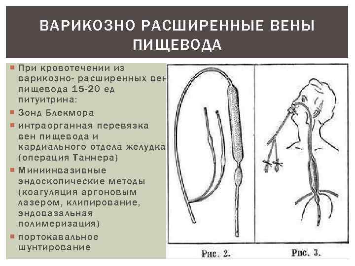 ВАРИКОЗНО РАСШИРЕННЫЕ ВЕНЫ ПИЩЕВОДА При кровотечении из варикозно- расширенных вен пищевода 15 -20 ед