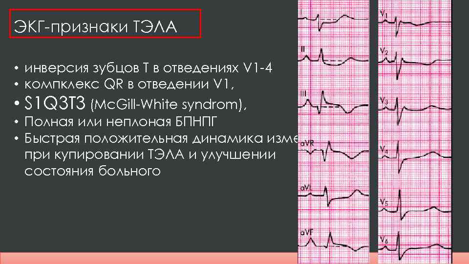 Экг отрицательный. Синдром s1 q3 на ЭКГ. Отрицательный зубец т на ЭКГ В v1 v2. ЭКГ Тэла s1 q3. Инверсия зубца т в v4-v6.