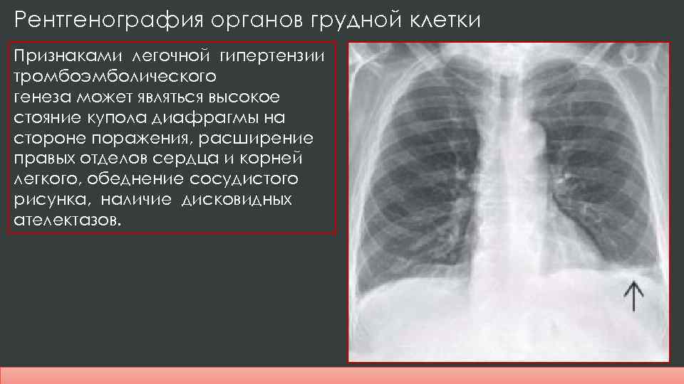 Дилатация правых отделов. Рентгенография грудной клетки при Тэла. Рентген грудной клетки при легочной гипертензии. Тэла на рентгене критерии.