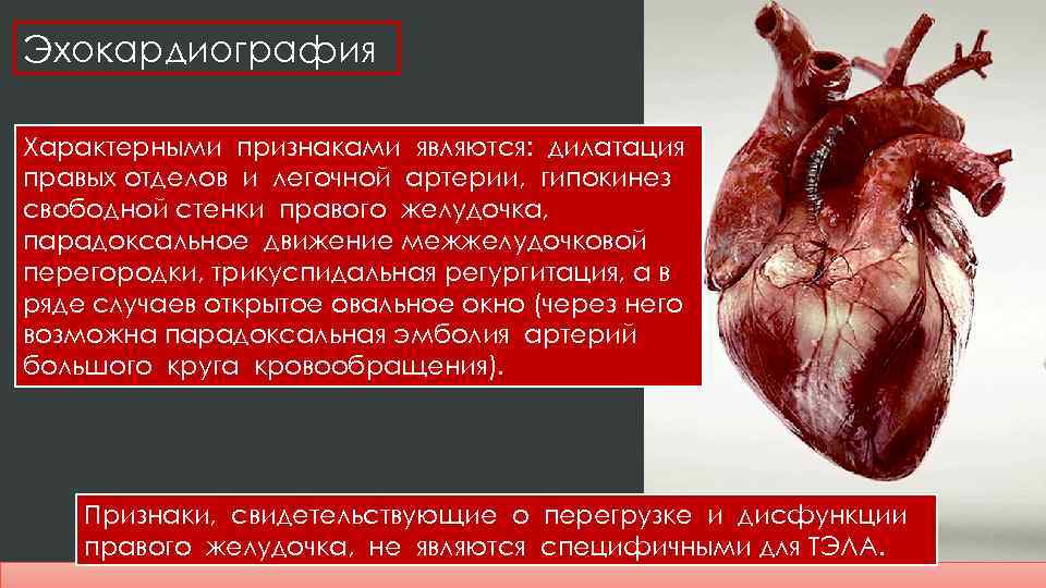 Эхокардиография Характерными признаками являются: дилатация правых отделов и легочной артерии, гипокинез свободной стенки правого