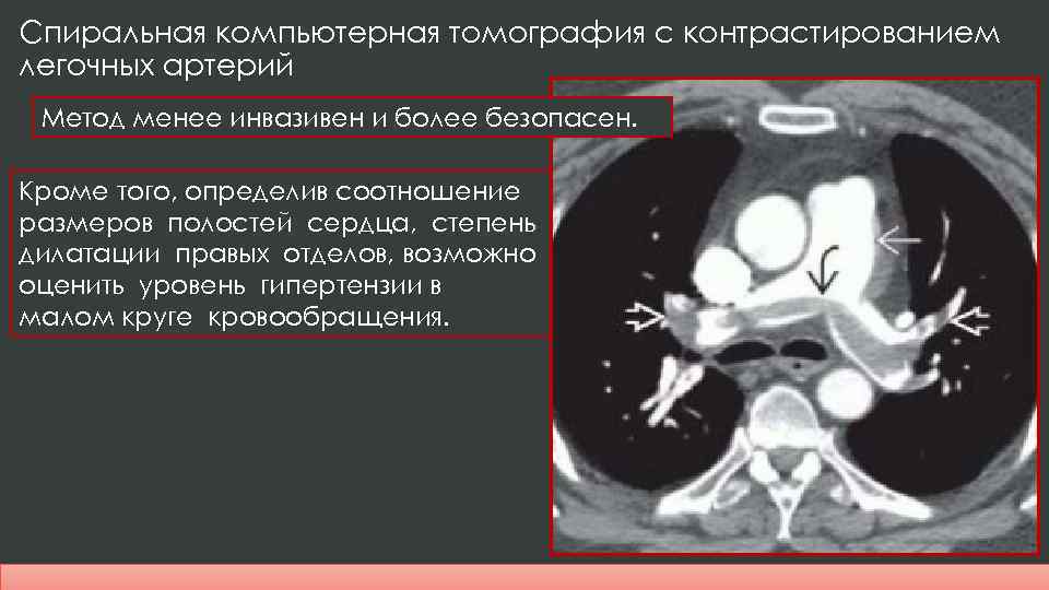 Дилатация правых отделов. Тромбоэмболия легочной артерии на кт с контрастом. Легочная тромбоэмболия кт. Тромбоэмболия легочной артерии на кт.