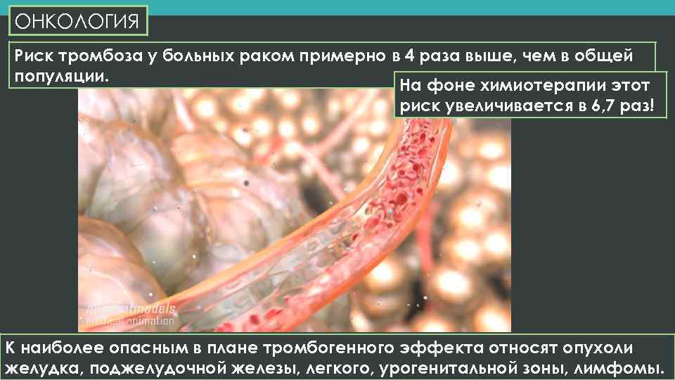 ОНКОЛОГИЯ Риск тромбоза у больных раком примерно в 4 раза выше, чем в общей