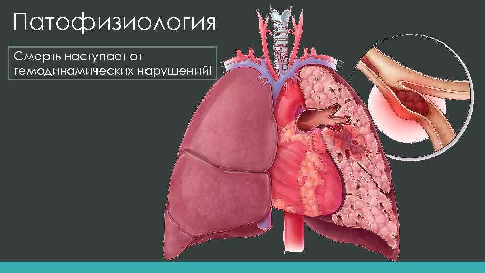 Патофизиология Смерть наступает от гемодинамических нарушений! 