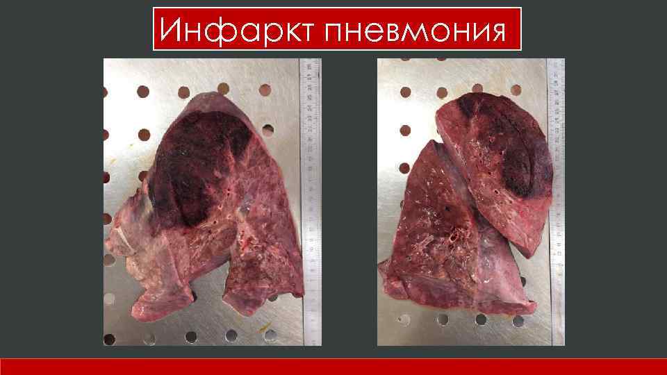 Инфаркт пневмония 