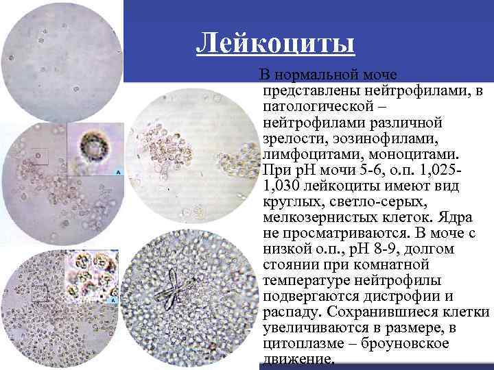 Лейкоциты В нормальной моче представлены нейтрофилами, в патологической – нейтрофилами различной зрелости, эозинофилами, лимфоцитами,