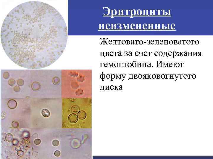 Эритроциты неизмененные Желтовато-зеленоватого цвета за счет содержания гемоглобина. Имеют форму двояковогнутого диска 