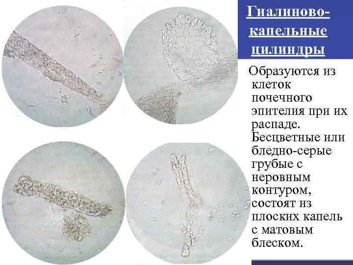 Гиалиновокапельные цилиндры Образуются из клеток почечного эпителия при их распаде. Бесцветные или бледно-серые грубые