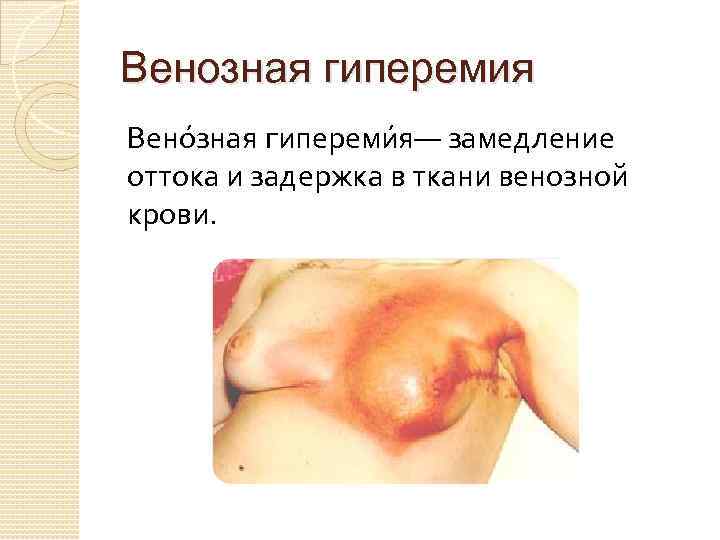 Венозная гиперемия Вено зная гипереми я— замедление оттока и задержка в ткани венозной крови.