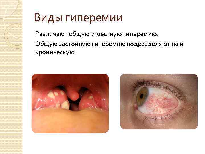 Виды гиперемии Различают общую и местную гиперемию. Общую застойную гиперемию подразделяют на и хроническую.