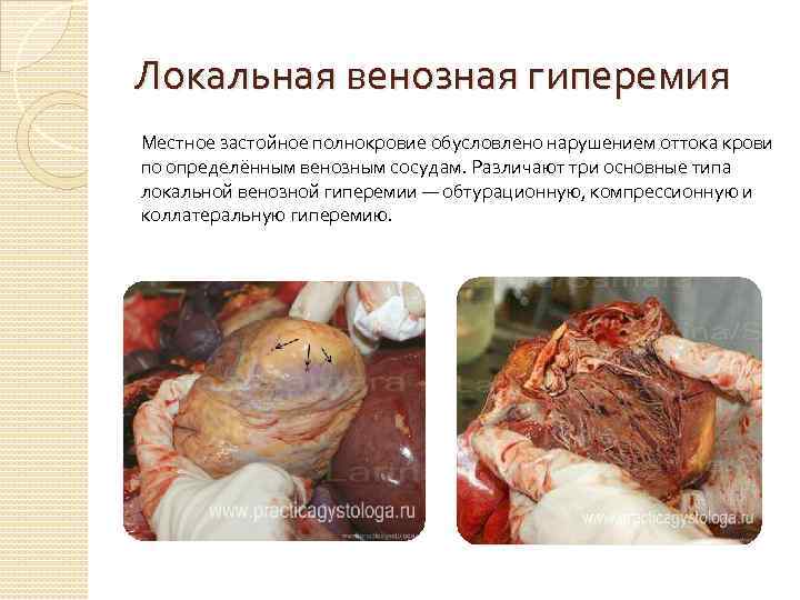 Локальная венозная гиперемия Местное застойное полнокровие обусловлено нарушением оттока крови по определённым венозным сосудам.