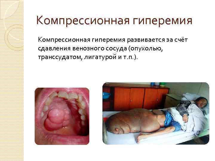 Компрессионная гиперемия развивается за счёт сдавления венозного сосуда (опухолью, транссудатом, лигатурой и т. п.