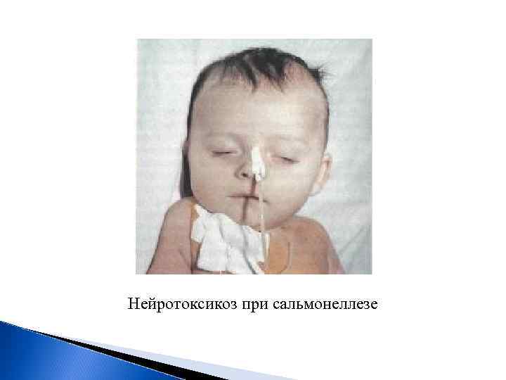 Нейротоксикоз при сальмонеллезе 