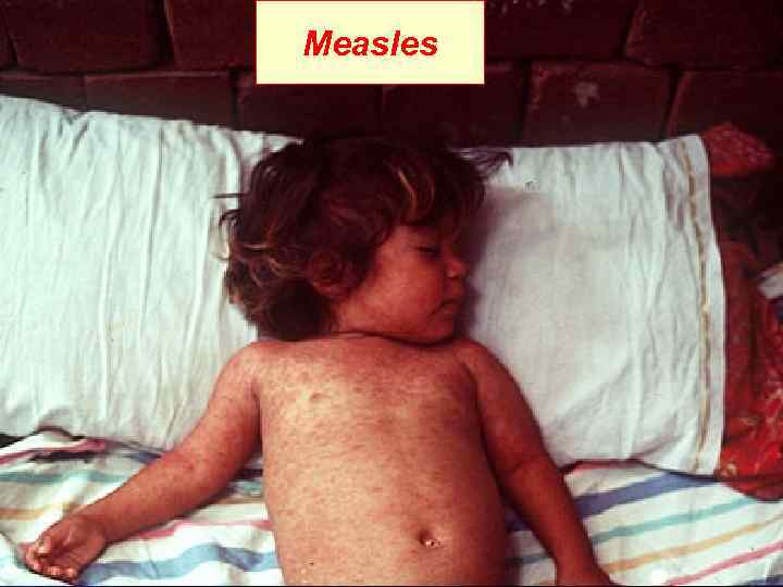 Measles 