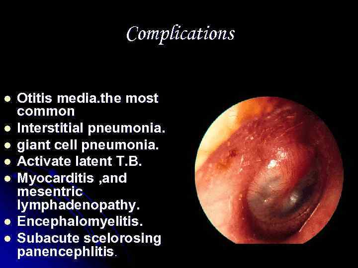 Complications l l l l Otitis media. the most common Interstitial pneumonia. giant cell