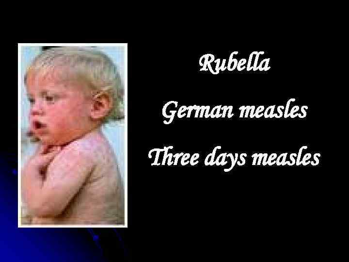 Rubella German measles Three days measles 