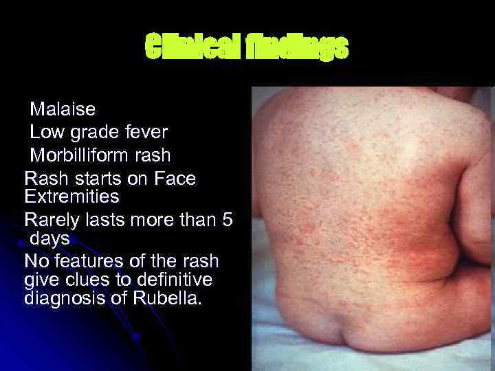 Clinical findings Malaise Low grade fever Morbilliform rash Rash starts on Face Extremities Rarely