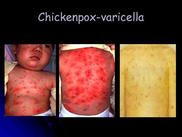 Chickenpox-varicella 
