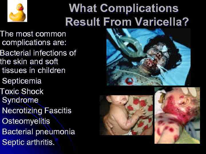 What Complications Result From Varicella? The most common complications are: Bacterial infections of the