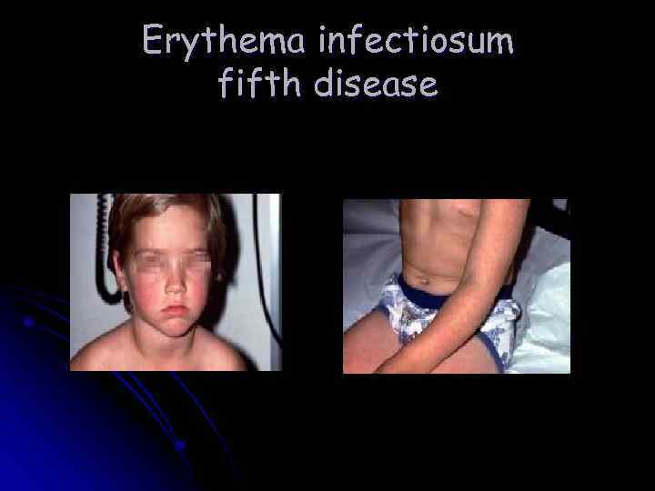 Erythema infectiosum fifth disease 