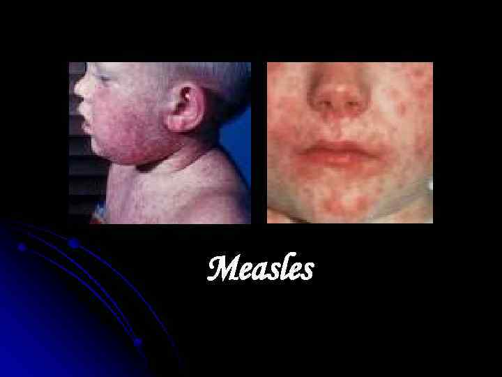 Measles 