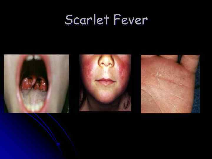 Scarlet Fever 