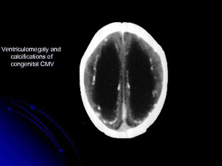 Ventriculomegaly and calcifications of congenital CMV 