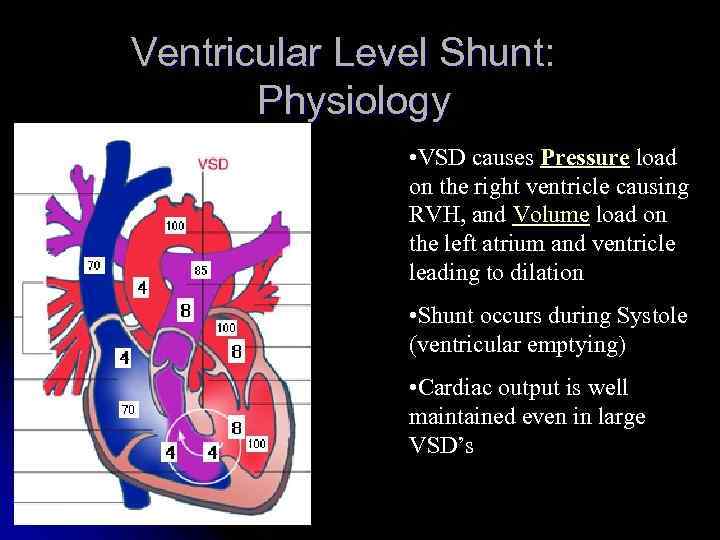 Ventricular Level Shunt: Physiology • VSD causes Pressure load on the right ventricle causing