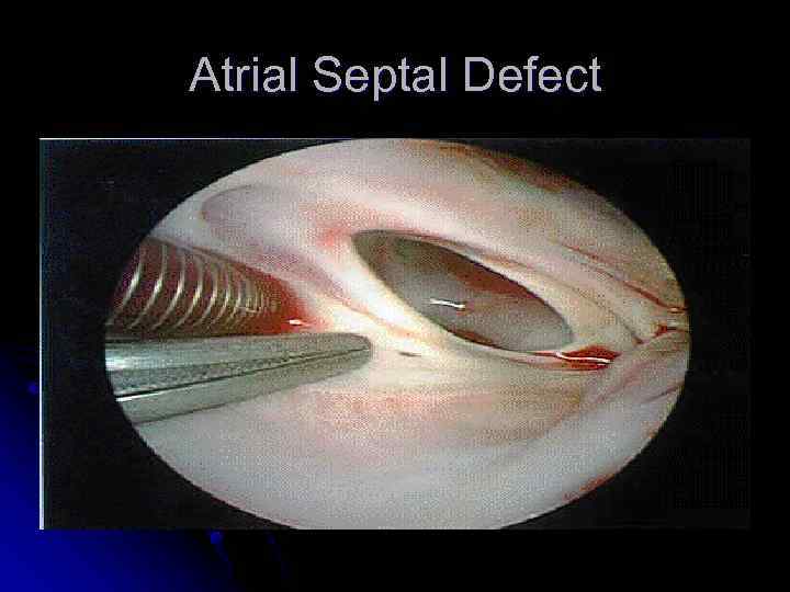 Atrial Septal Defect 