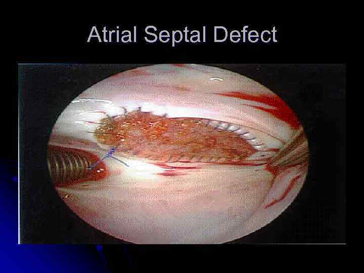 Atrial Septal Defect 