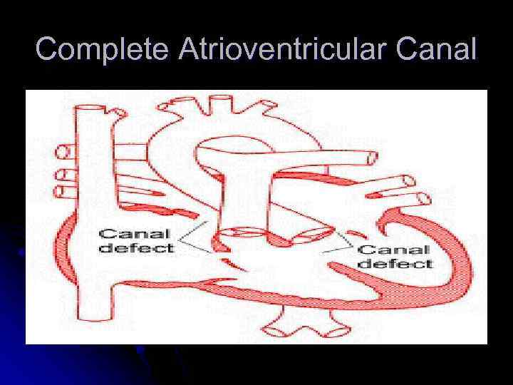 Complete Atrioventricular Canal 