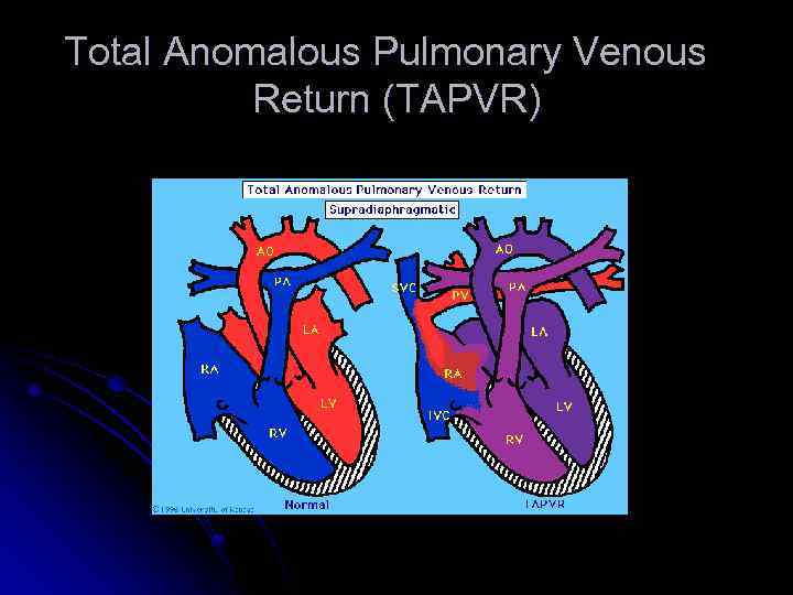 Total Anomalous Pulmonary Venous Return (TAPVR) 