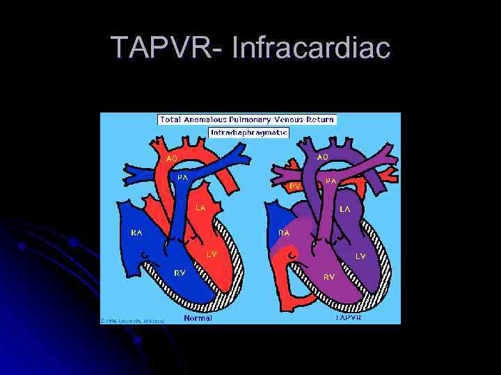 TAPVR- Infracardiac 