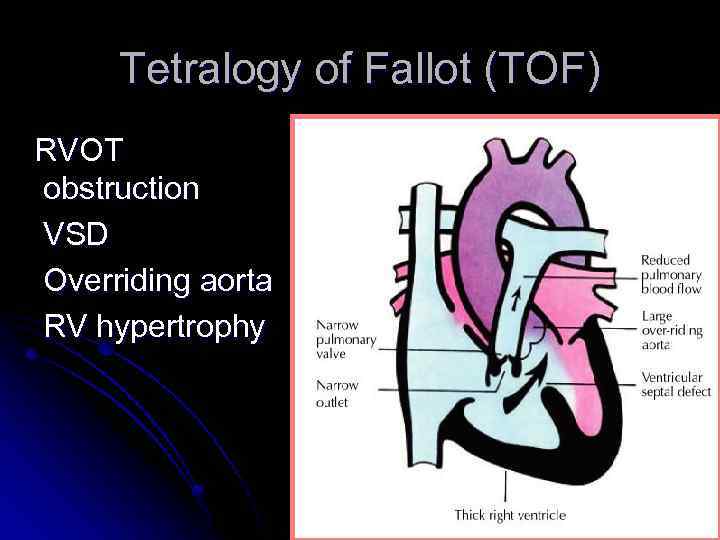 Tetralogy of Fallot (TOF) RVOT obstruction VSD Overriding aorta RV hypertrophy 