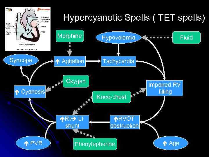 Hypercyanotic Spells ( TET spells) Morphine Syncope Hypovolemia Agitation Tachycardia Oxygen Cyanosis Knee-chest Rt