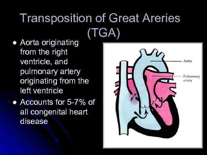 l l Transposition of Great Areries (TGA) Aorta originating from the right ventricle, and