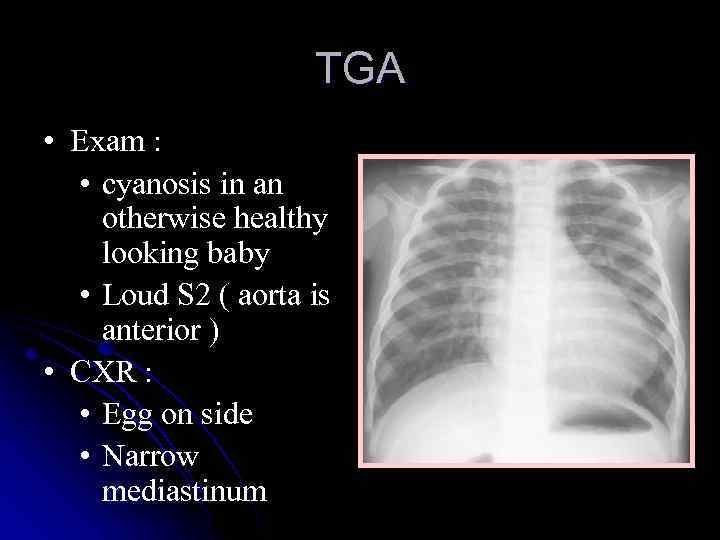 TGA • Exam : • cyanosis in an otherwise healthy looking baby • Loud