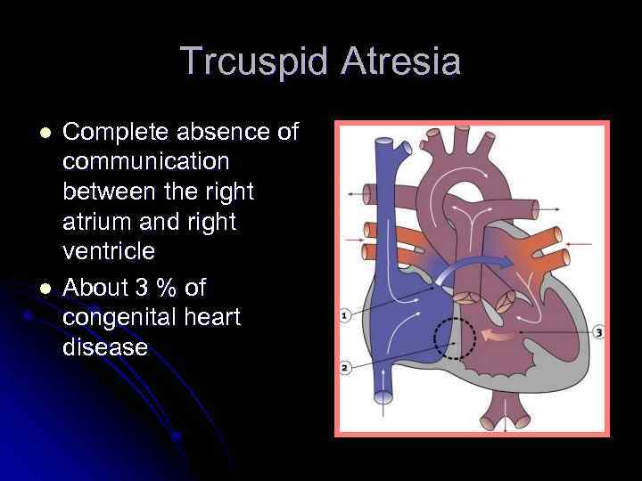 Trcuspid Atresia l l Complete absence of communication between the right atrium and right