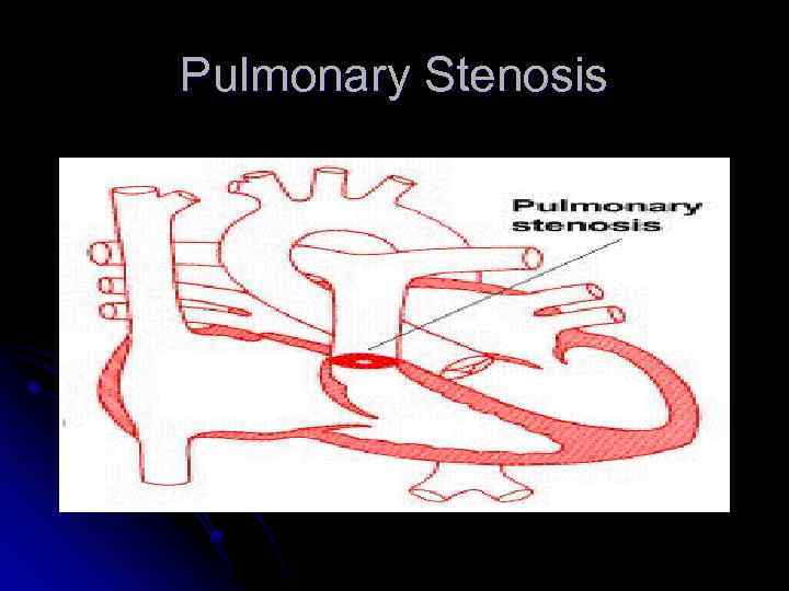 Pulmonary Stenosis 