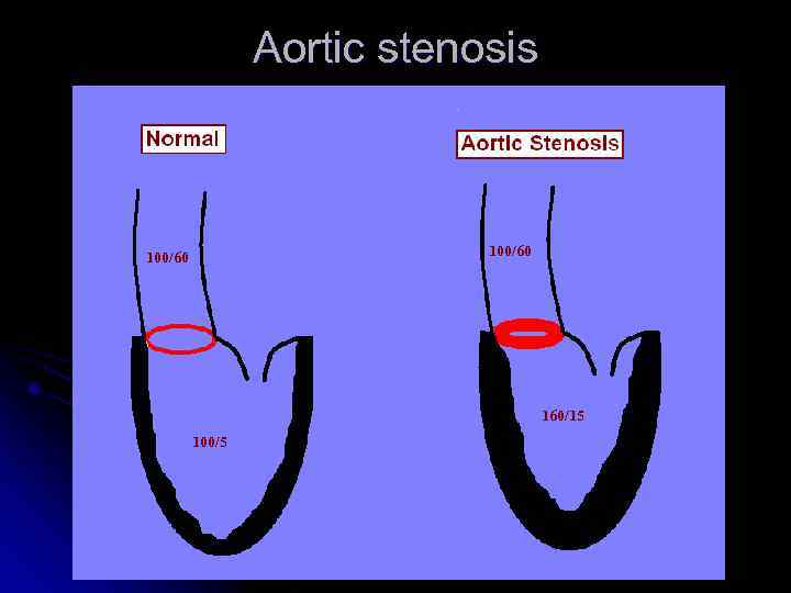 Aortic stenosis 100/60 160/15 100/5 