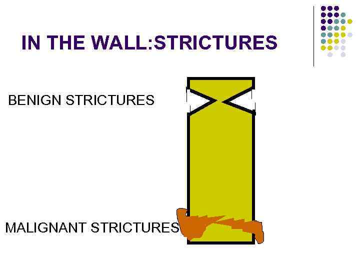 IN THE WALL: STRICTURES BENIGN STRICTURES MALIGNANT STRICTURES 
