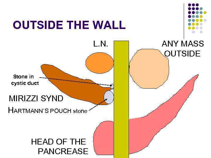 OUTSIDE THE WALL L. N. Stone in cystic duct MIRIZZI SYND HARTMANN`S POUCH stone