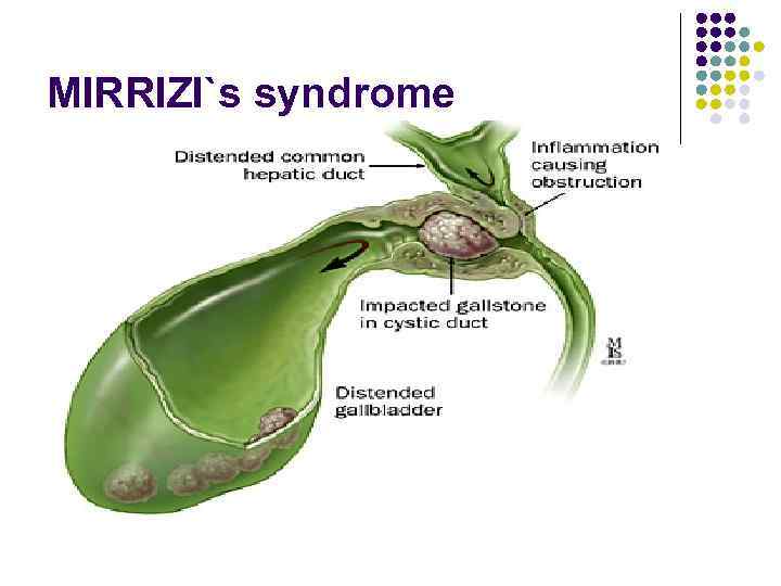MIRRIZI`s syndrome 