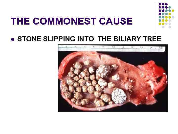 THE COMMONEST CAUSE l STONE SLIPPING INTO THE BILIARY TREE 